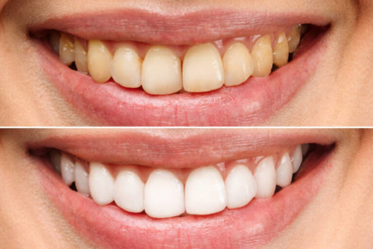 Using Coconut Oil to Naturally Whiten Your Teeth