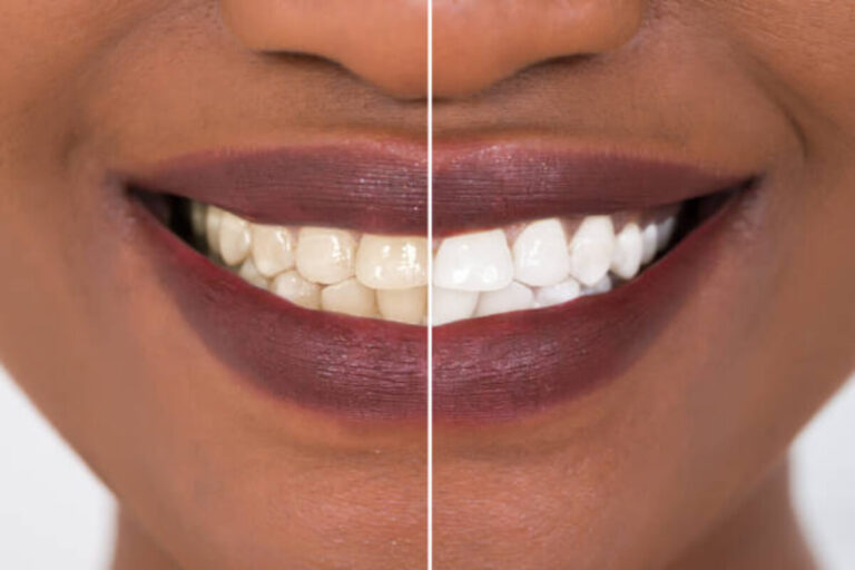 How to Naturally Whiten Your Teeth